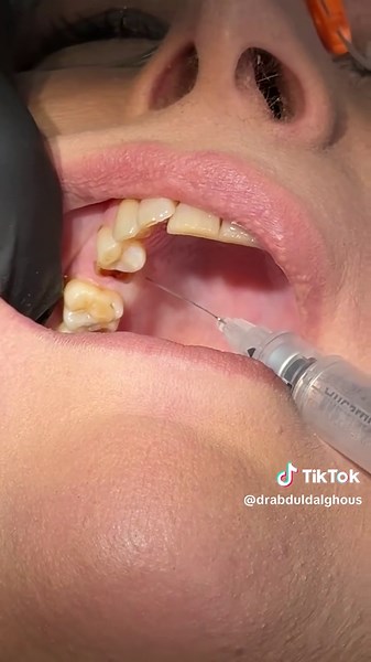 Upper Premolar Anaesthesia Techniques for Dental Students