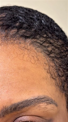 100 Days After My Hair and Eyebrow Transplant… 👀