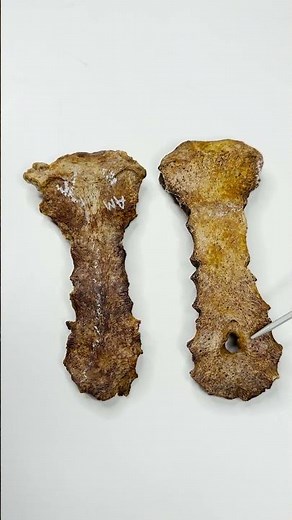 Sternal Foramen