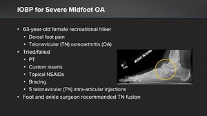In-clinic IOBP® Procedure for Midfoot Osteoarthritis