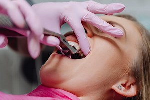 Alveolitis Seca 🦷: Qué es, causas y prevención