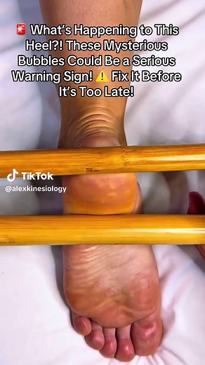 Those aren’t just calluses or bruises — those bubble-like spots could mean your foot is suffocating from the inside. This pressure technique exposed hidden congestion and poor lymph flow. If your feet look anything like this… don’t ignore it. It could be the start of chronic pain, TMJ issues, or adrenal fatigue. Fix it before it spreads. Hashtags: #FootBoiling #HeelDangerSigns #DetoxThroughFeet #KinesiologyCheck #FixItBeforeItSpreads #V#ViralMassage #H#HealingTouch #P#PainReliefHack #B#BodyHack 