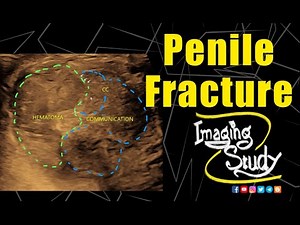 Penile Fracture || Ultrasound || Case 337