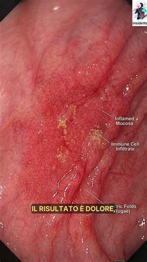 What is an ulcer really? Here is what happens to your mucosa! #biology #medicine #curiosity