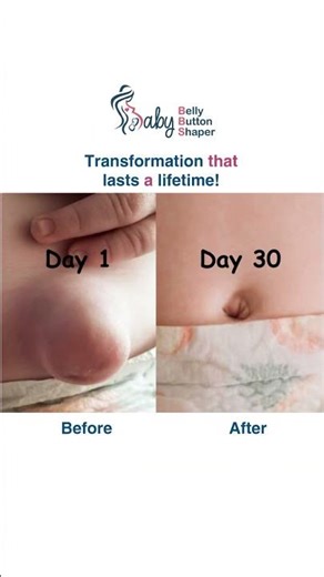 Link in bio! A lifetime result starts with the Baby Belly Button Shaper kit! #newbornmusthaves #baby