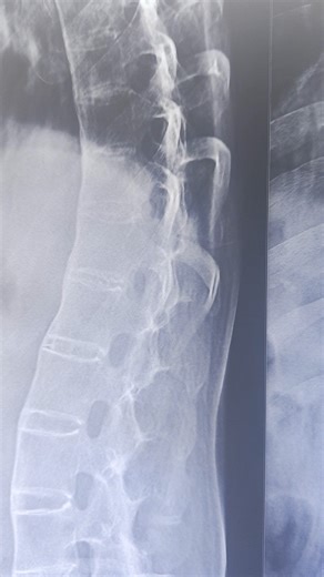 1.6K views · 18 reactions | Ankylosing Spondylitis Explained | Why...