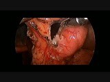 Laparoscopic Resection of Gastric GIST • Video • MEDtube.net