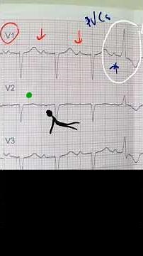 PAC or PVC ECG, Dr Alaa Nasr