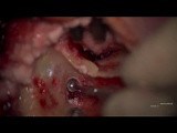 Endoscopic Cholesteatoma Surgery with Mastoid Obliteration • Video • MEDtube.net