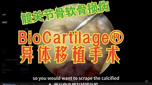 髋关节骨软骨损伤：BioCartilage® 异体移植手术