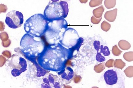 Amibe « mangeuse de cerveau » : deux cas mortels récents aux Etats-Unis