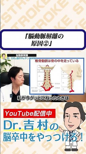 脳動脈解離の原因② #脳動脈解離 #治療法 #脳卒中 #脳出血 #くも膜下出血 #兵庫医科大学 #医学生 #研修医