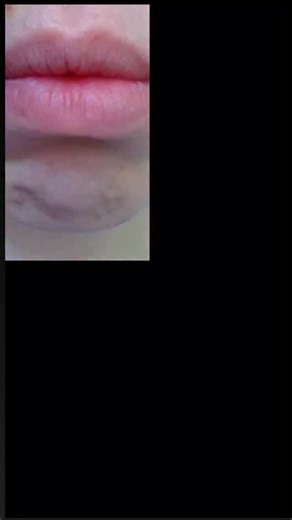 1.2K views · 26 reactions | A dimpled or puckered chin when your...