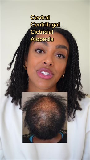 Understanding CCCA Alopecia Treatment and Solutions