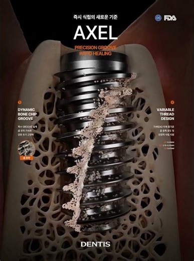 AXEL Implant | Diseño que mejora la osteointegración y la estabilidad primaria