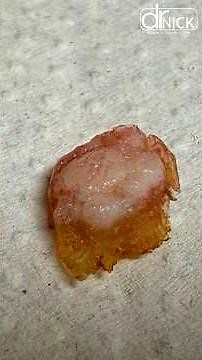 LARGE PLANTAR WART REMOVED!!😳🤯