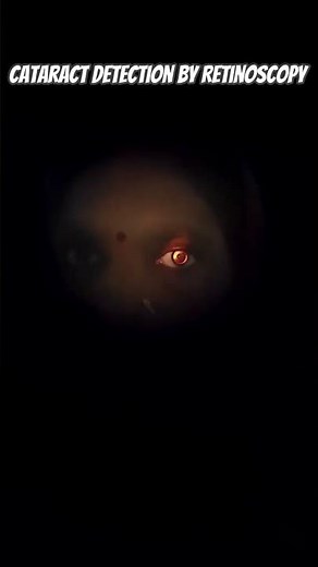 Cataract Detection by Retinoscopy|How Cataract Affects Retinoscopy Reflex?#retinoscopy#cataract