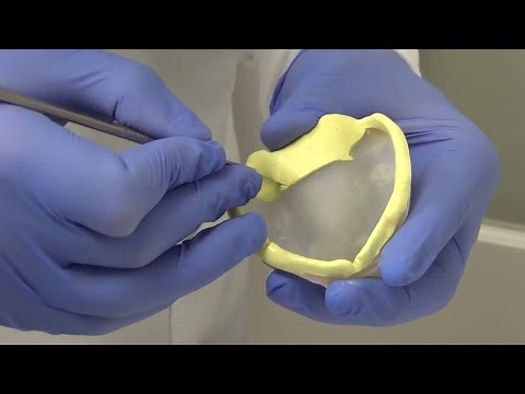 Custom Tray and PVS Edentulous Final Impression of the Maxilla