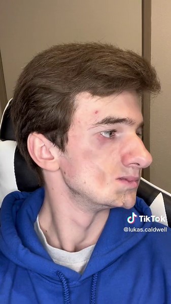 Blowing Air into Cheeks Post-Jaw Surgery | Painful Reaction