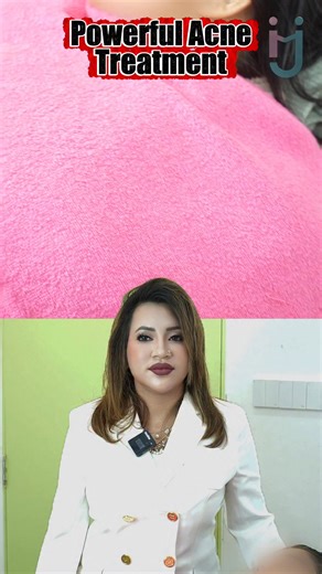 16K views · 315 reactions | Powerful Acne Treatment | Dr. Israt Jahan | Facebook