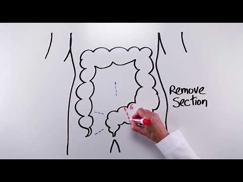 Sigmoidectomy (Short version)