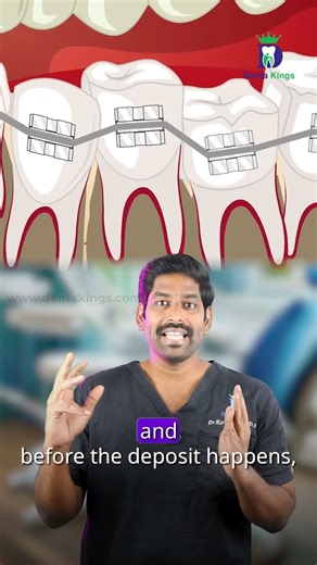 கிளிப் சிகிச்சையை அவசரப் படுத்தாதீர்கள் - Don't rush your orthodontic treatment | Denta Kings