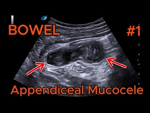 Bowel – Appendiceal Mucocele – Clip 1 B-mode + Color