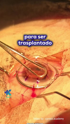 Trasplante de Córnea: Todo sobre la Cirugía para Miopía