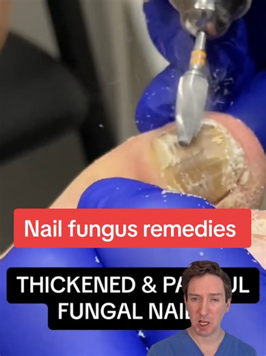 Effective Home Remedies for Toenail Fungus Treatment