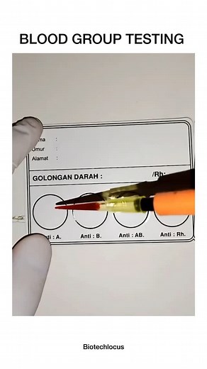 BIOTECH LOCUS | Blood group testing involves mixing a blood sample with specific antibodies. If the blood clumps (agglutinates), it indicates the presence... | Instagram