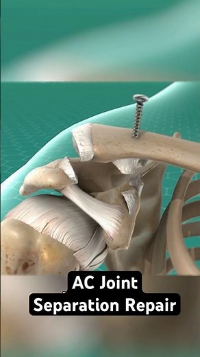 Screwing a separated shoulder into place (3D Animation)