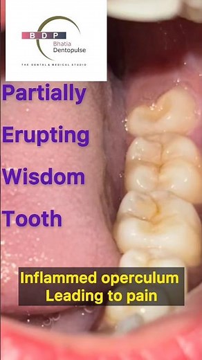 Is your wisdom tooth causing PAIN? Watch this before getting it removed #teethpain #dentist