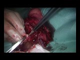 Uniportal VATS Sleeve Bilobectomy (Right Main Bronchus to RUL) • Video • MEDtube.net