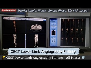 Filming | CECT Lower Limb Angiography| By Anis Qureshi