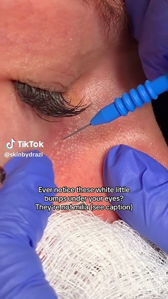 They’re normal sebaceous glands (oil glands). You don’t need to do anything, you can forget about them. In some, even from a young age they appear more prominent and may be described as chicken skin. But they’re smooth and NOT milia. In thinner skin types or those with under eye volume loss they’re more noticeable. Even though they’re normal, the appearance may bother some. In this video, I’m using tiny Needle device to electrodessicate them. You can also use a retinol eye cream like EyeglowPM t