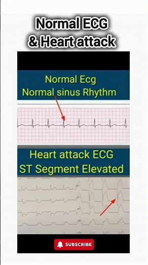 Normal ECG vs Heart Attack ECG Explained | Recognize the Signs of a Heart Attack