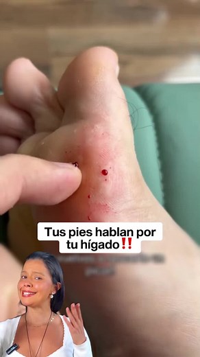 Síntomas del hígado: Cuida tu salud y desintoxícate