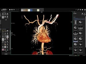 CT Chest & whole abdomen triphasic phase