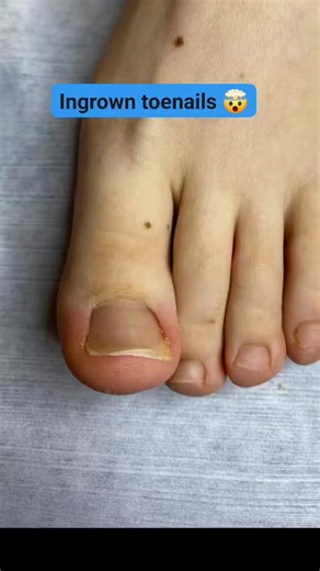 42K views · 132 reactions | Ingrown nails treatment  #fyp #painrelief #treatment | Toe NaiIs | Facebook