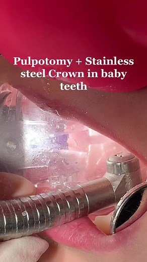 Pediatric Dentistry: Pulpotomy and Stainless Steel Crown Procedure