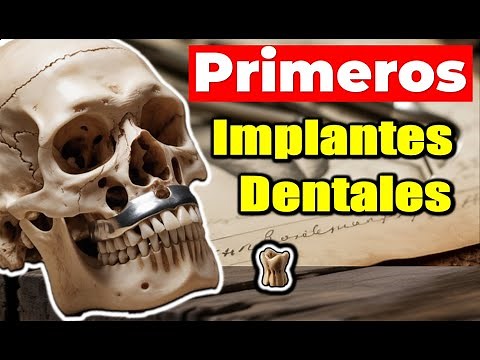 Cómo nació el Implante Dental? Conoce su Interesante Historia!