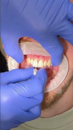 Front Tooth Dental Implant Transformation | Final Crown Fitting