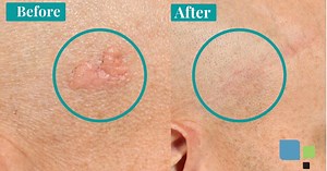 Should I Have Mole Removal on My Face? (Before and After Photos) – Primera Plastic Surgery