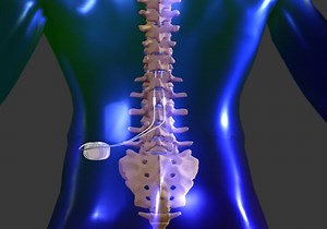 Spinal Cord Stimulation | Carolinas Pain Center