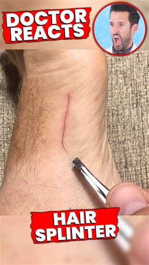 Doctor ER on Instagram: "Doctor Reacts to “Most Satisfying” Removal of Hair Splinter 😱"
