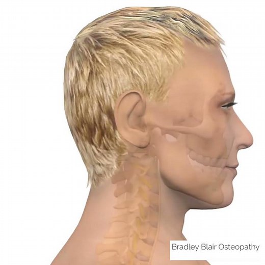 Ossified Posterior Longitudinal Ligament