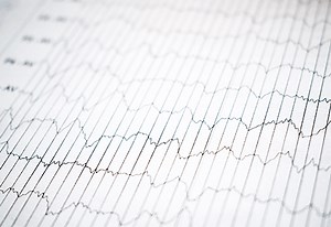 Cardiovascular Services: Comprehensive Electrophysiology Study from CVG Cares Cardiologists | CVG