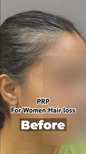 Female PRP Results | Treatment For Women Hair Loss Before & After