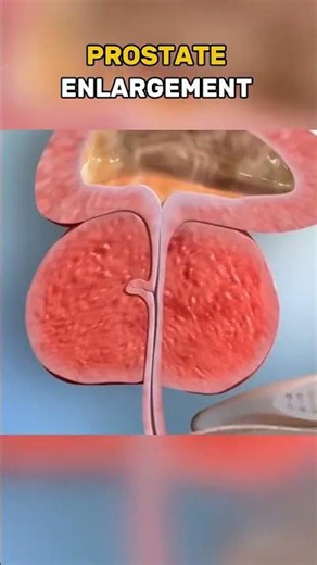 Vasectomy Procedure Explained | 3D Medical Animation #Vasectomy #MensHealth