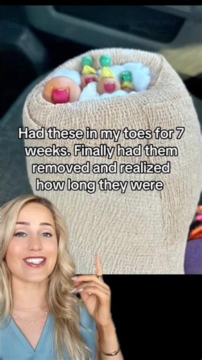 The part of foot surgery they DON’T talk about